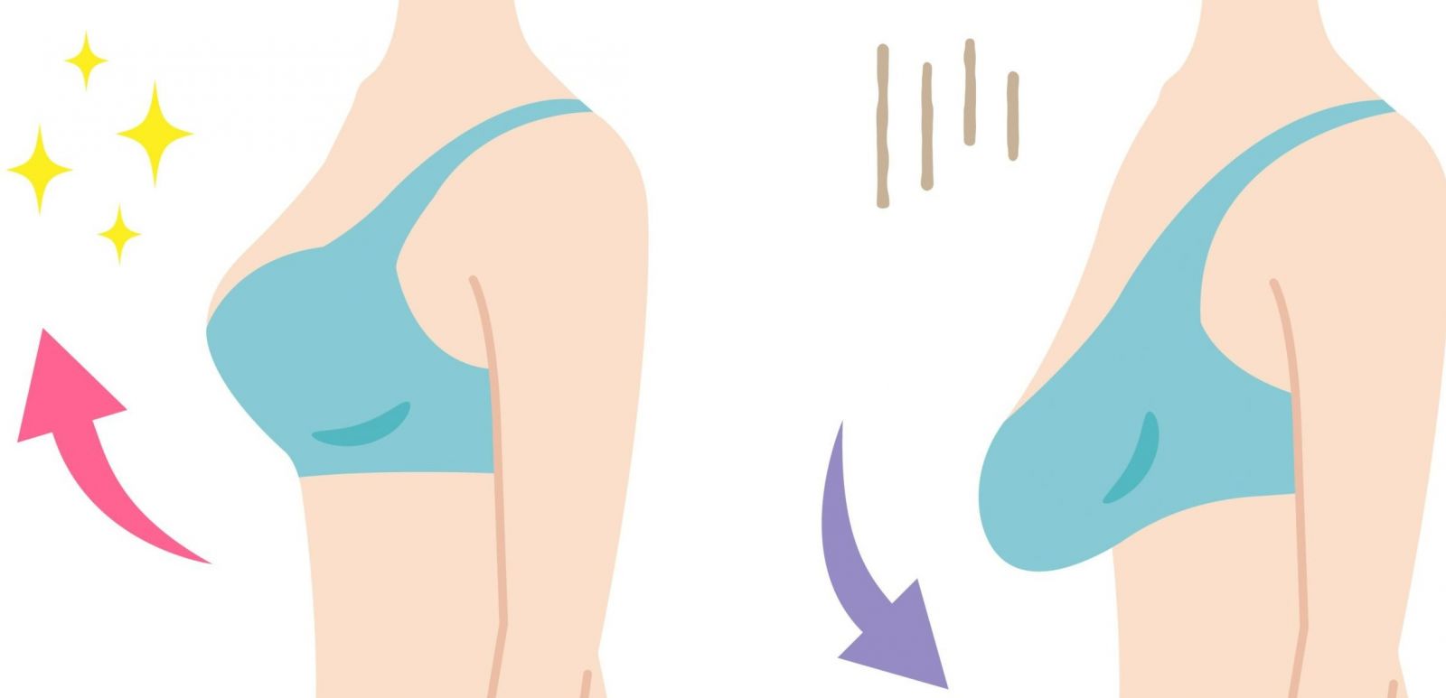 Breast ptosis : severity, causes and treatment