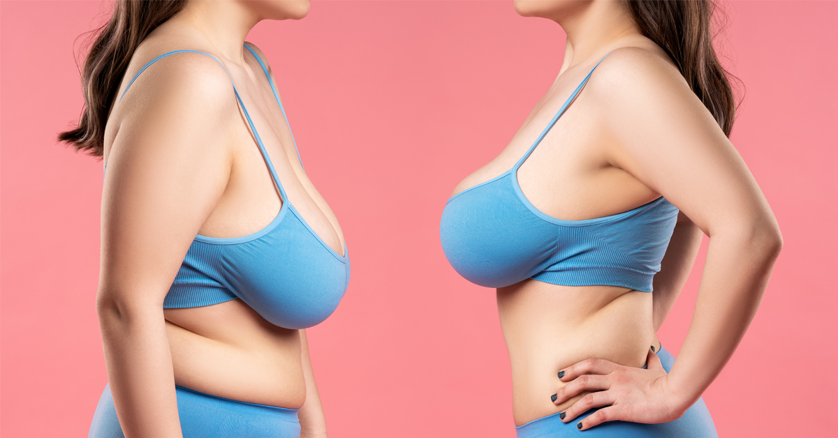 Breast ptosis : an augmentation by prosthesis in Turkey