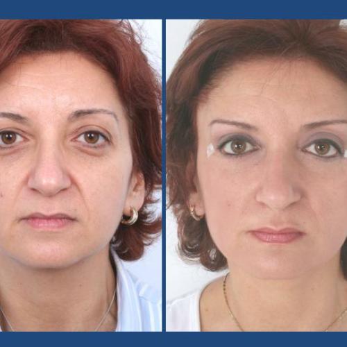 Before after photos of our patients - Eyelid surgery - Prof. Dr. Gürhan Özcan