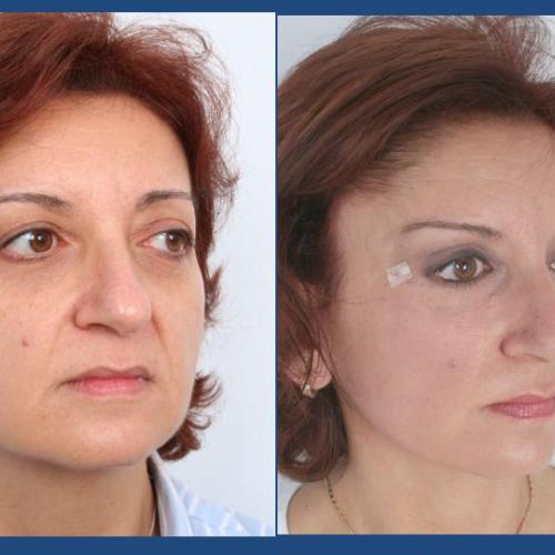 Before after photos of our patients - Eyelid surgery - Prof. Dr. Gürhan Özcan