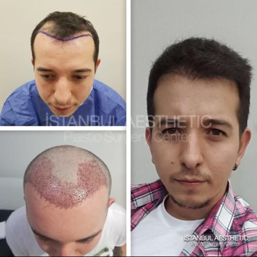 Пересадка волос Фотографии до и после