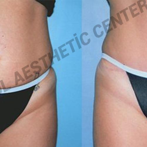 Liposuccion Photos avant & après