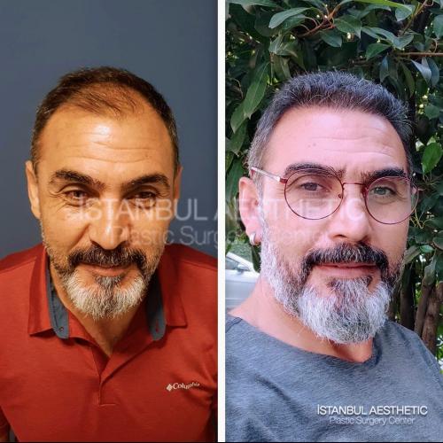 Пересадка волос Фотографии до и после