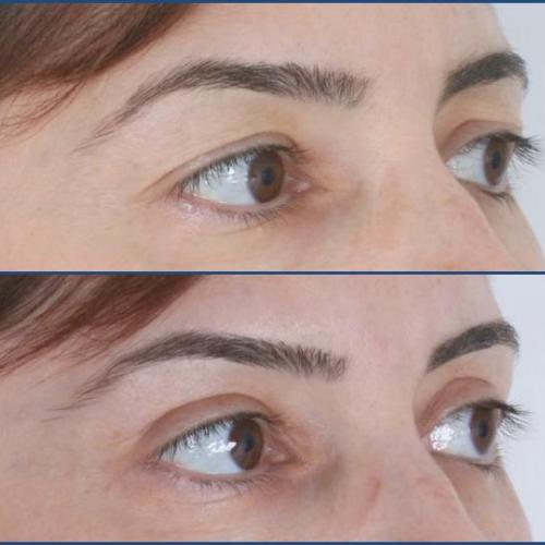 Before after photos of our patients - Eyelid surgery - Prof. Dr. Gürhan Özcan