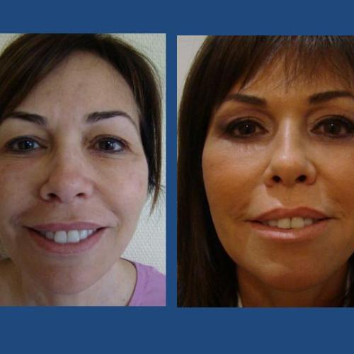 Before after photos of our patients - Eyelid surgery - Prof. Dr. Gürhan Özcan
