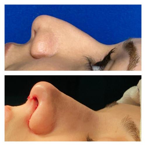 عملية تجميل الأنف صور قبل وبعد