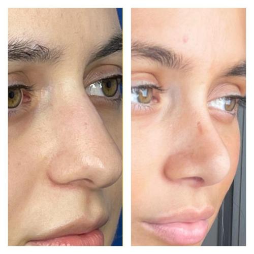رأب و تجميل الحاجز الأنفي صور قبل وبعد