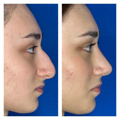 عملية تجميل الأنف صور قبل وبعد