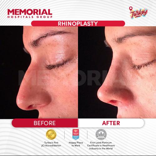 تصغير فتحات الأنف صور ماقبل / ما بعد