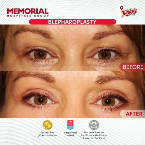 الجراحة التجميلية صور قبل وبعد