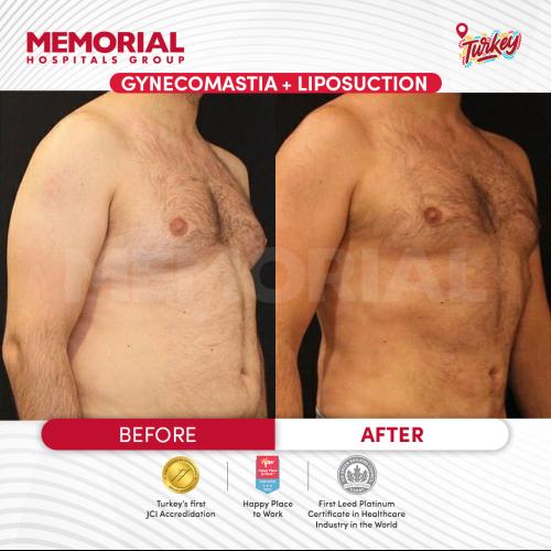 Tratamiento de ginecomastia (con liposucción) Foto antes/después