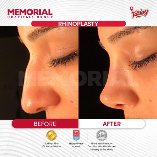تصغير فتحات الأنف صور ماقبل / ما بعد
