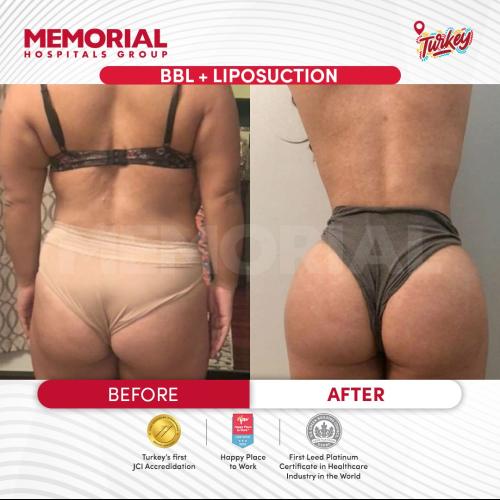J plasma Renuvion Before / After photo