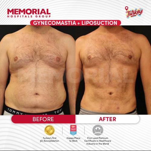 Tratamiento de ginecomastia (con liposucción) Foto antes/después