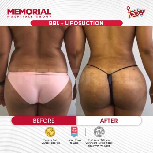 J plasma Renuvion Before / After photo