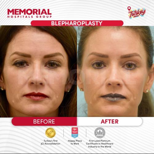 الجراحة التجميلية صور قبل وبعد