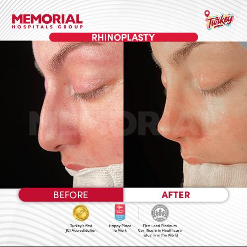 تصغير فتحات الأنف صور ماقبل / ما بعد