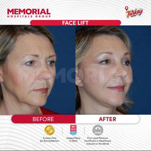 Before after photos of our patients 11