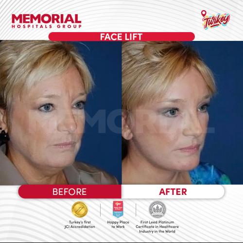 صور قبل وبعد لمرضانا 2