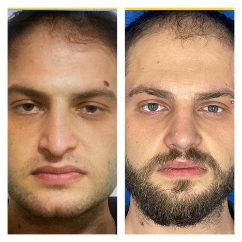 Septoplasty Before / After photo