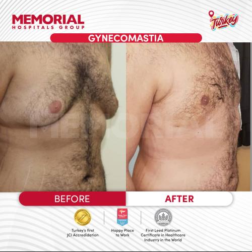 Tratamiento de ginecomastia (con liposucción) Foto antes/después