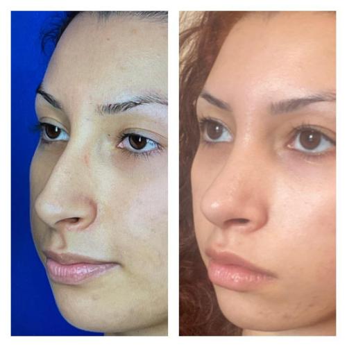 fotos antes y después de nuestros pacientes 11