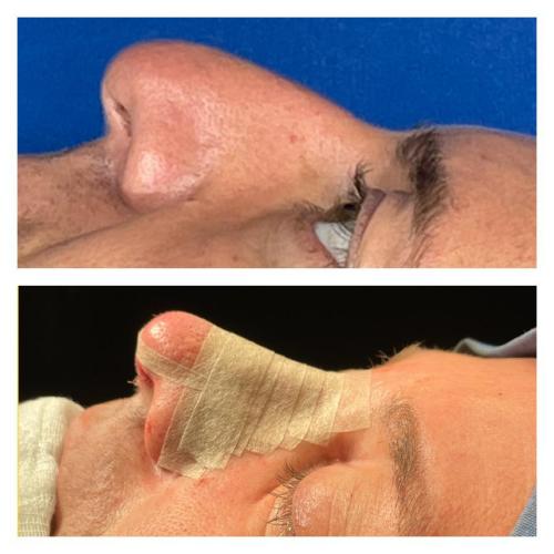 Rhinoplastie Photo avant/après
