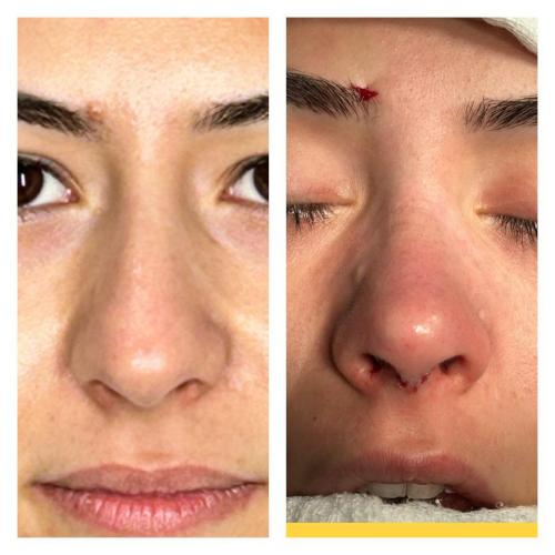 Septoplasty Before / After photo