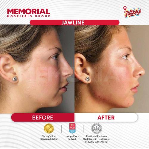 Jawline contouring Photo avant/après