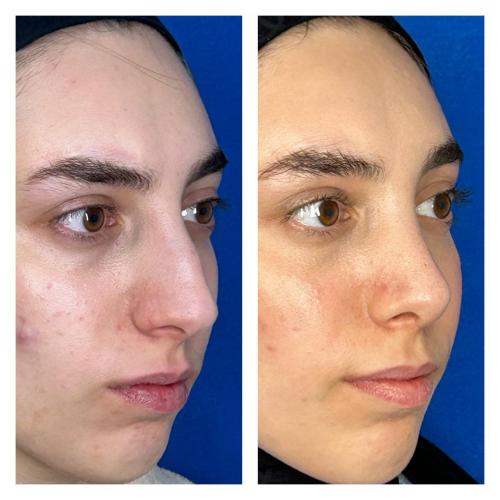 Septoplasty Before / After photo