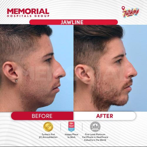 Jawline contouring Photo avant/après