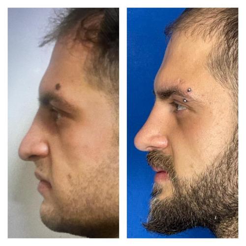 Septoplasty Before / After photo