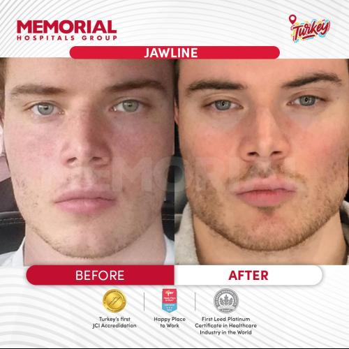 Jawline contouring Photo avant/après