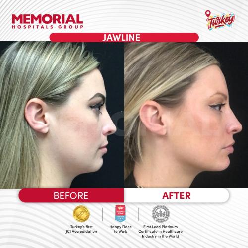 Jawline contouring Photo avant/après