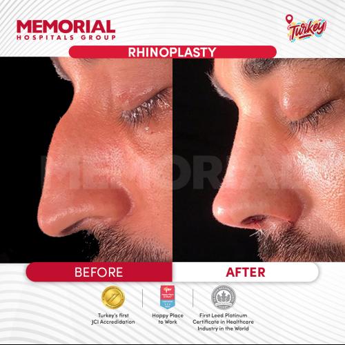 تصغير فتحات الأنف صور ماقبل / ما بعد