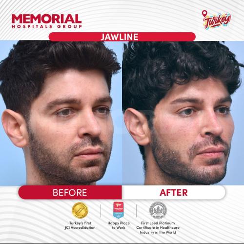 Jawline contouring Photo avant/après