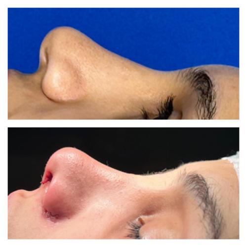 Septoplasty Before / After photo