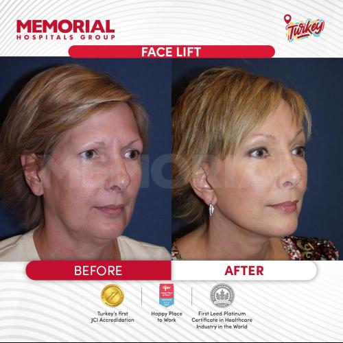 Photos Avant / Après 6