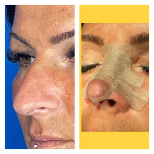 Septoplasty Before / After photo