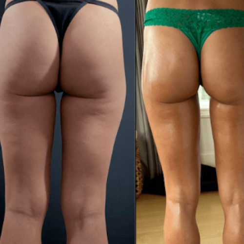 Liposucción Láser Foto antes/después