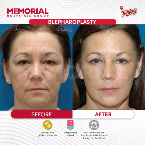 Photos Avant / Après 4