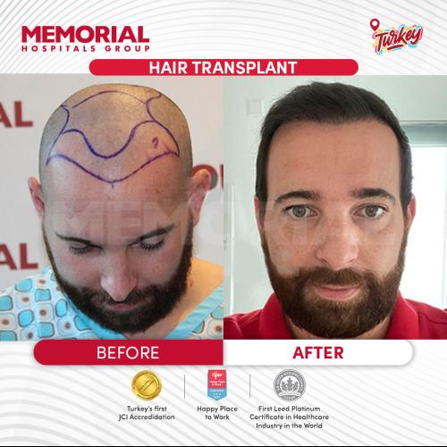 Photos Avant / Après 2