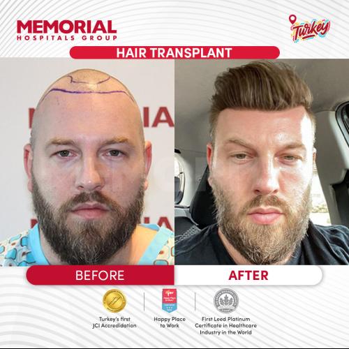 Trasplante de barba Foto antes/después