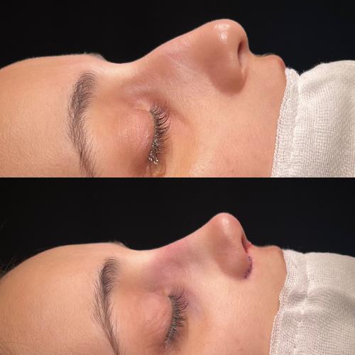 Ultrasound Rhinoplasty Before / After photo