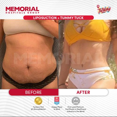 Abdominoplastie Photos avant & après