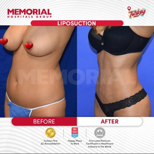 Before after photos of our patients 0