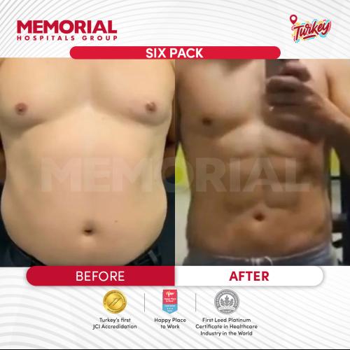 Abdominal Etching Photo avant/après