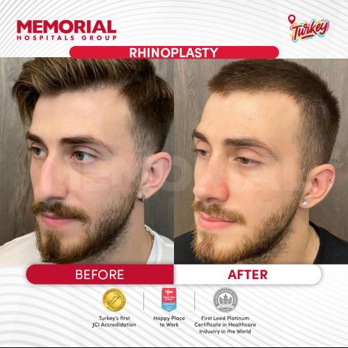 Rhinoplastie Photo avant/après
