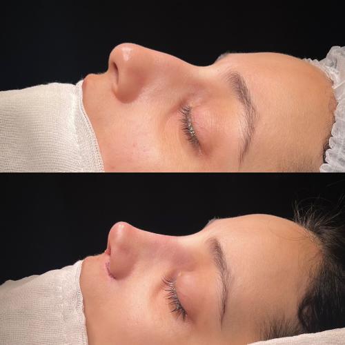 Ultrasound Rhinoplasty Before / After photo