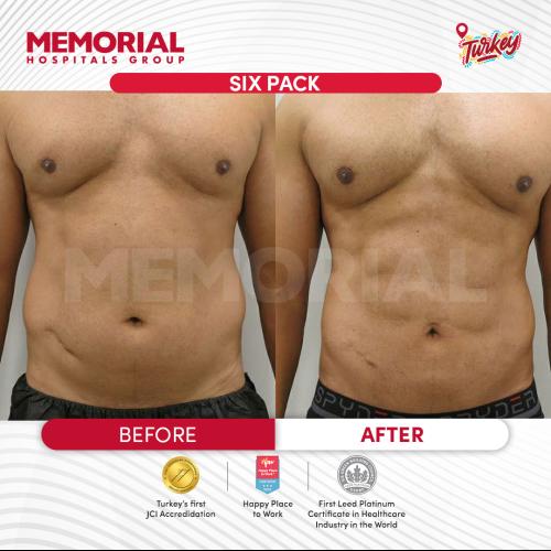 Abdominal Etching Photo avant/après
